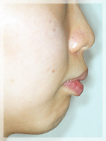 上顎前突02 Before